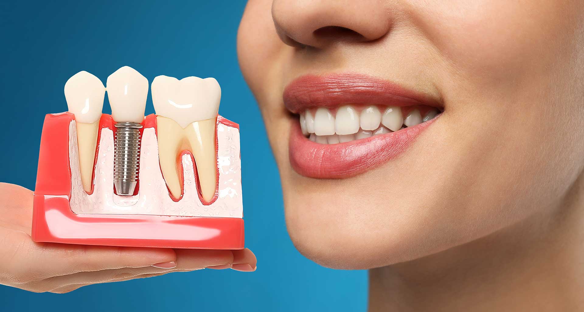 Dental İmplant Yaptırmanın Avantajları Nelerdir?